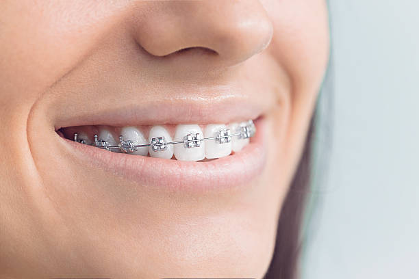 Best Veneers and Lumineers  in Momence, IL